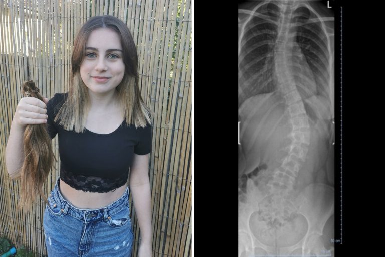 Teen, 14, fears she may never dance again in agonising wait for life changing spinal surgery