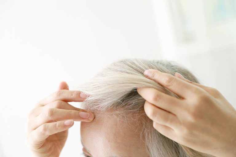 A quarter of Covid patients suffer hair loss in the six months after infection – and women are more…