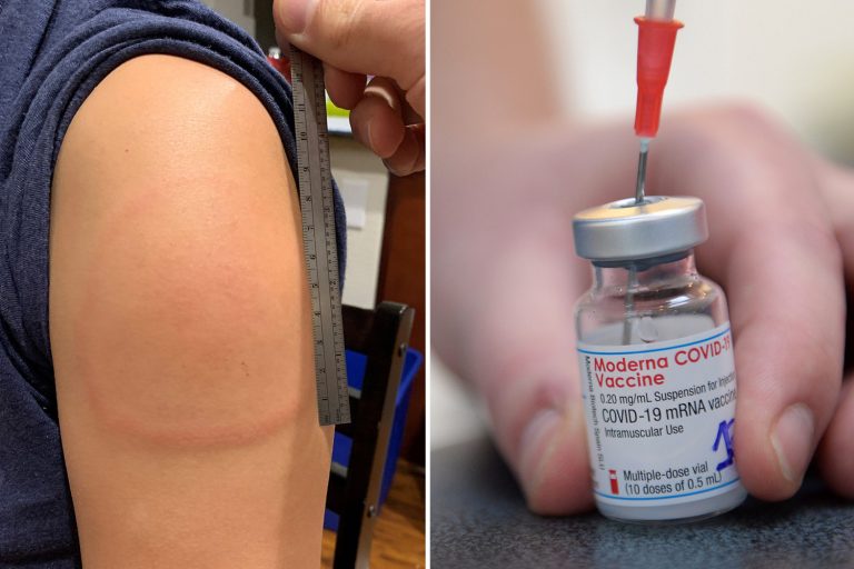 Moderna vaccine causing ‘Covid arm’ side effects in some patients