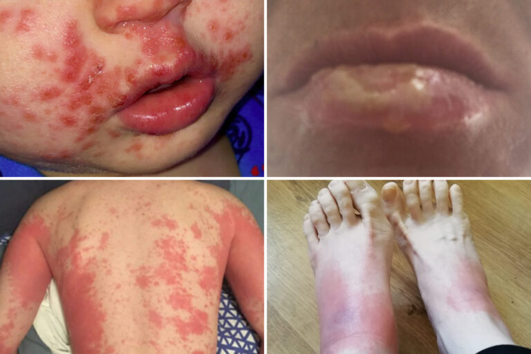 Skin rashes are the ONLY symptom for 1 in 5 Covid patients, docs warn