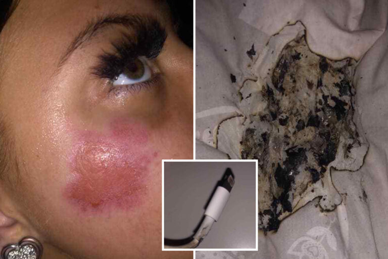 Girl, 17, left with burns to face after iPhone charger ‘set her duvet on fire while she was in bed’