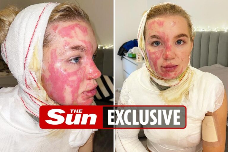 AJ Pritchard’s girlfriend Abbie begged him ‘Do you still love me?’ after fireball accident left her…
