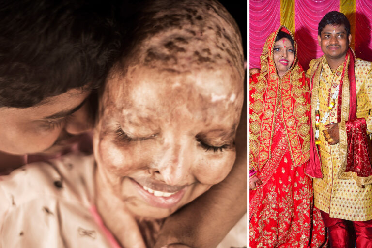 Acid attack survivor doused in petrol & set alight for ‘rejecting marriage proposal’ weds man she…