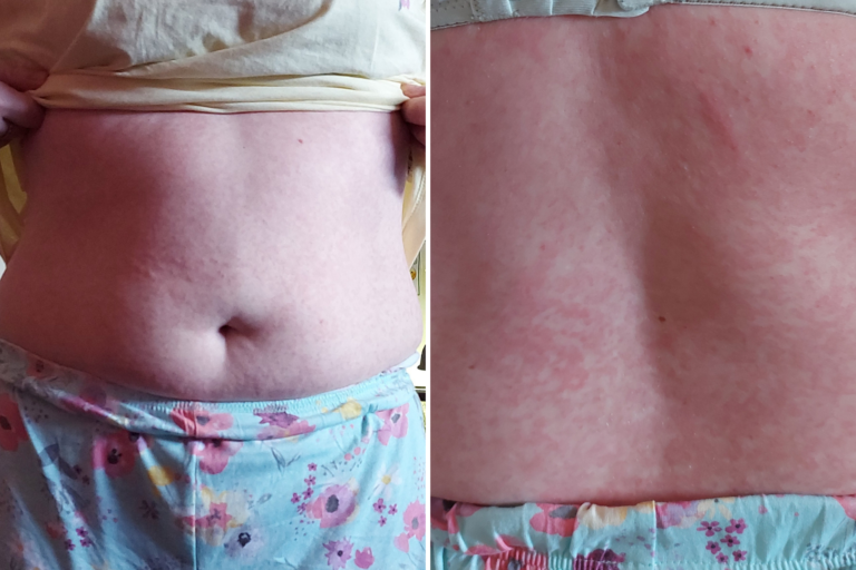 Scots mum refuses to change in front of husband & hides skin from kids because of horror rash after…