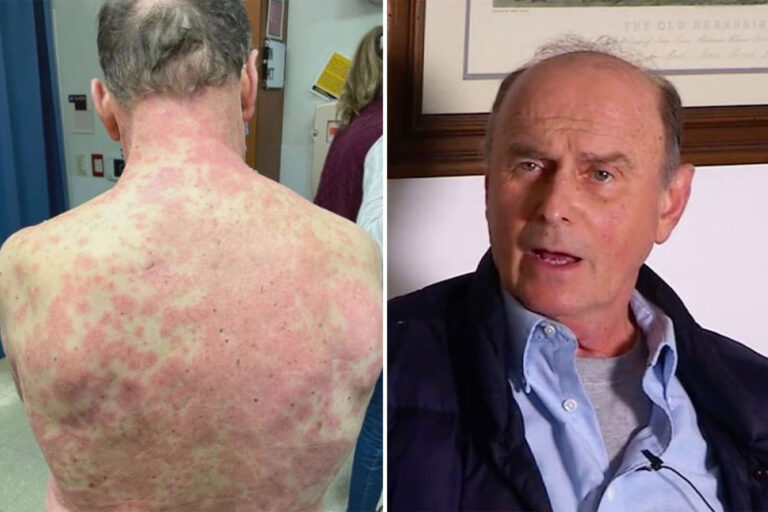 Virginia man, 74, gets ‘rare’ severe rash all over body and says his ‘skin peeled off’ after Johnson…