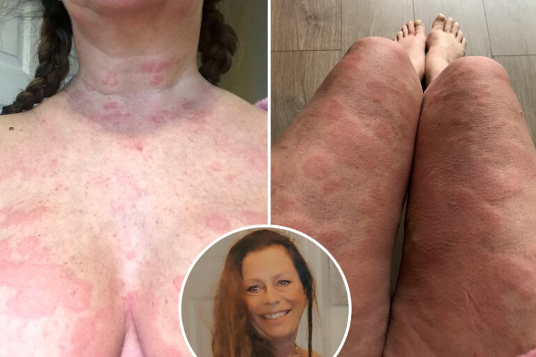 I was left looking like the creature from Alien after severe reaction to my Covid vaccine