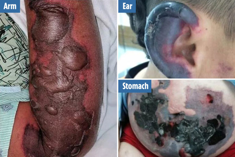 Grim photos show how cocaine can ROT your skin and genitals as drug use set to soar in post-lockdown…