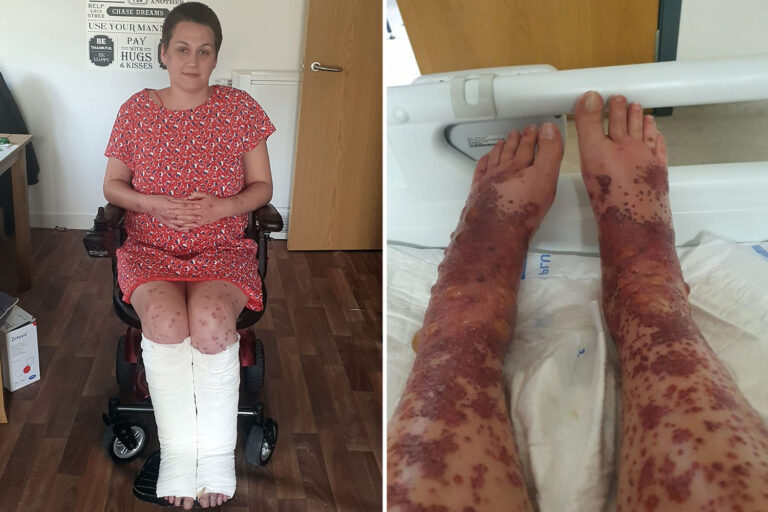 Mum’s legs erupted in rash and blisters after Covid vaccine but urges others to get jab