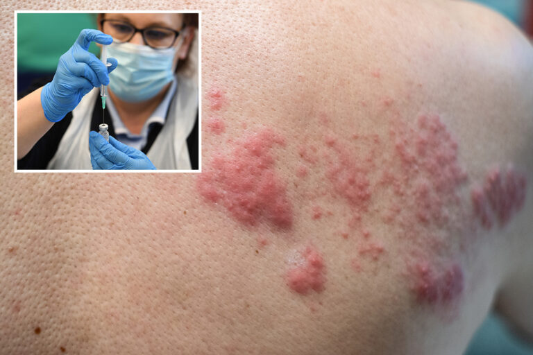 Shingles could be new but rare side effect of Covid vaccine, docs discover