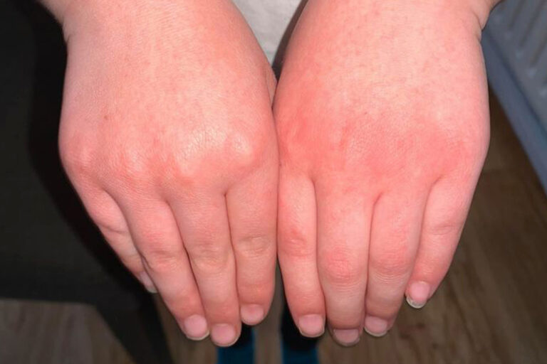Parents outraged as pupils left with ‘red raw’ hands from scrubbing up to ten times a day due to…