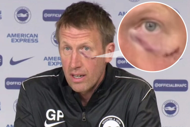 Brighton boss Graham Potter looks more like Harry Potter with huge scar on face after smashing into…