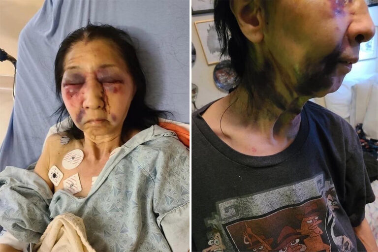 Horror injuries of Mexican woman, 70, ‘attacked by black woman who mistook her for being…