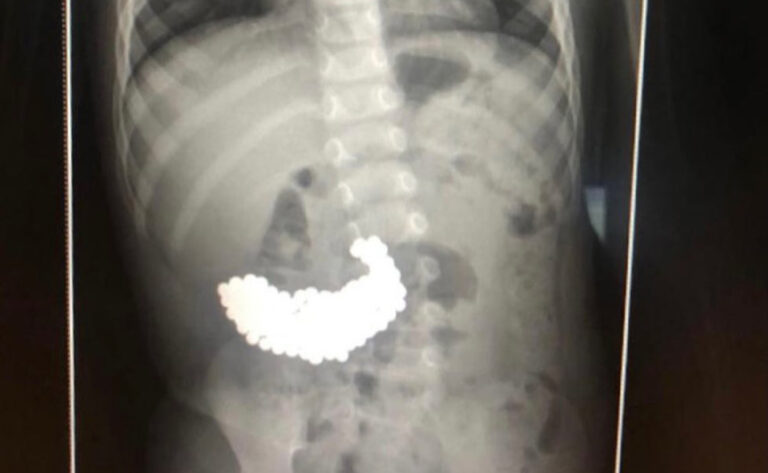 Surgeons in Russia remove 200 magnetic balls from toddler’s stomach swallowed TWO MONTHS earlier