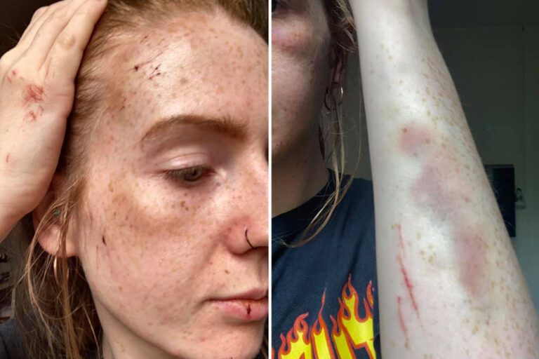 Shocking injuries of jogger battered by gang of men in random attack in Essex park