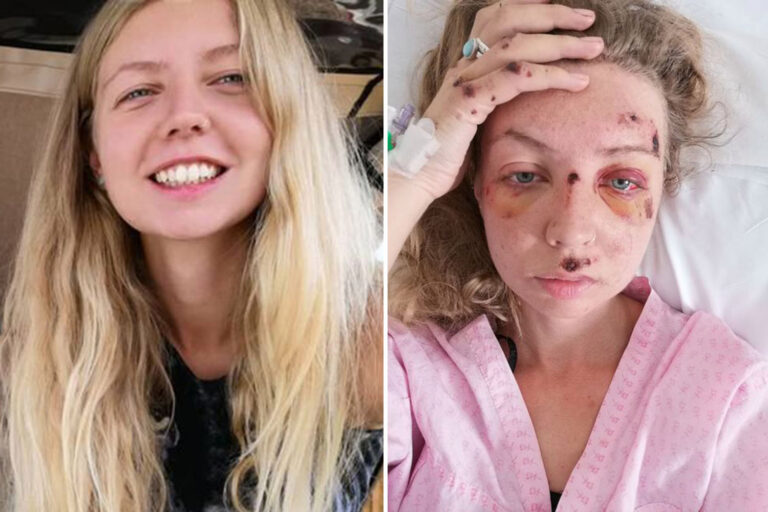 Woman, 26, left unable to walk after holiday roller-skating accident fractured her skull