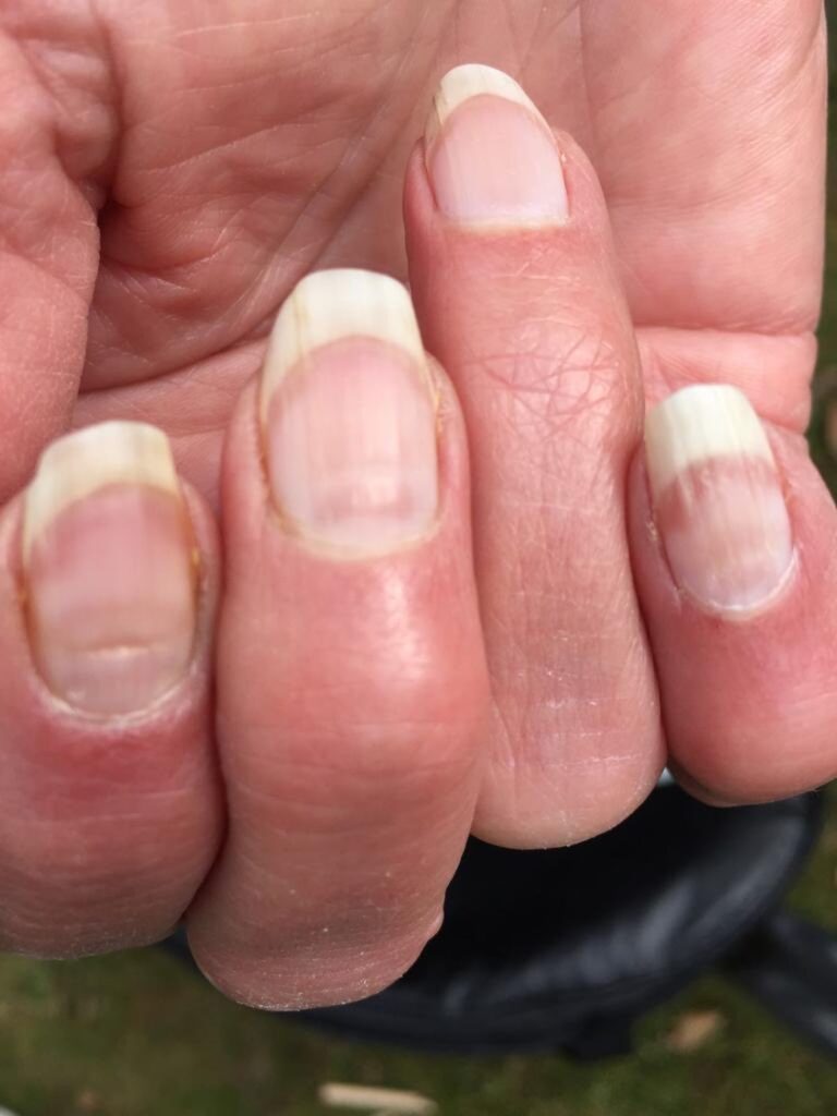 Covid ‘NAILS’ are latest new symptom to watch out for, says top expert