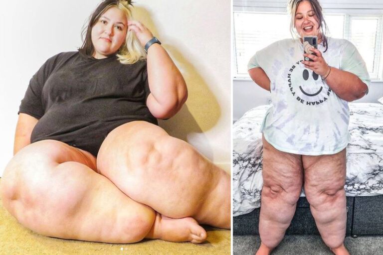 Mum, 29, with abnormally large legs due to chronic illness refused liposuction by NHS