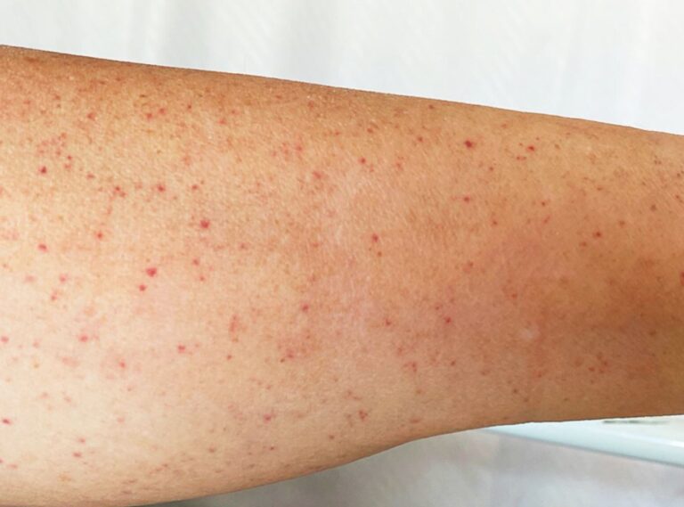 The 8 signs of bleeding condition linked to AstraZeneca Covid jab