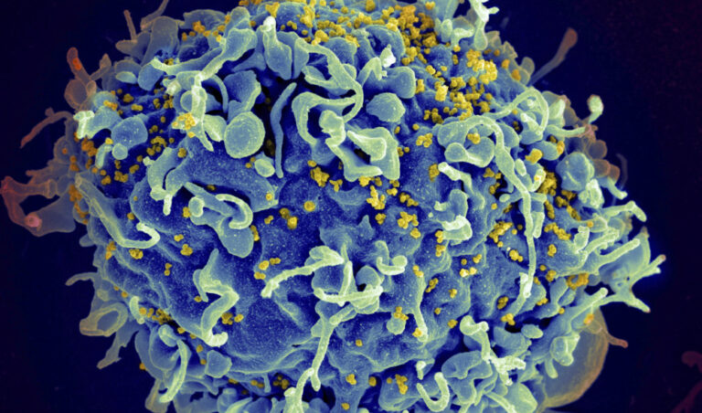 First woman reported cured of HIV after stem cell transplant