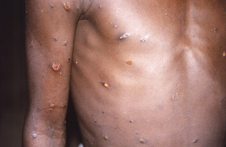 More than 700 monkeypox cases globally, 21 in US: CDC