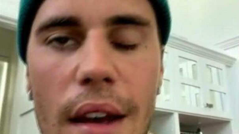 Justin Bieber reveals rare disorder behind facial paralysis